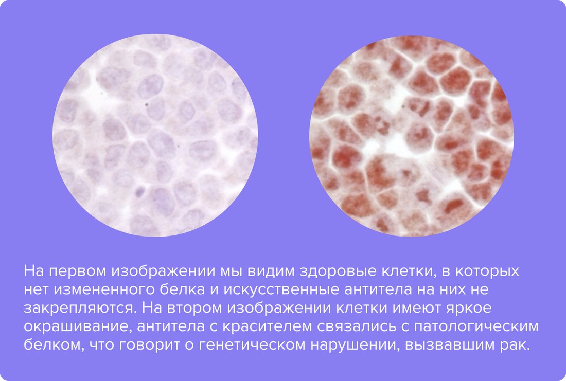 На первом изображении мы видим здоровые клетки, в которых нет измененного белка