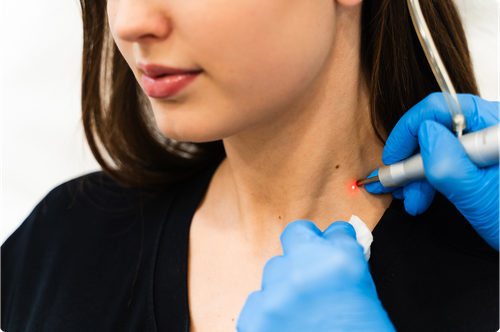 stock-photo-cosmetologist-applies-laser-removing-device-to-get-rid-of-birthmarks-laser-cleaning-skin-from-2486346375 1